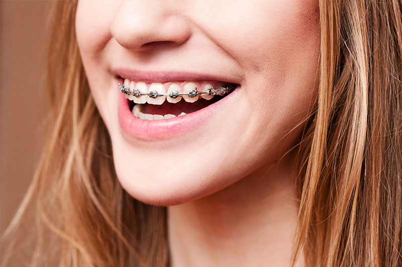 Orthodontics - Sam's Dental Office and Orthodontics, Fresno Dentist