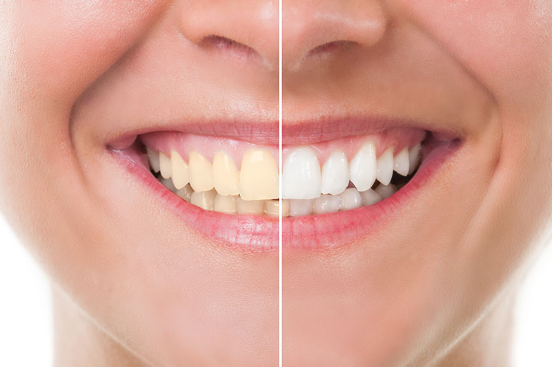 Teeth Whitening - Sam's Dental Office and Orthodontics, Fresno Dentist